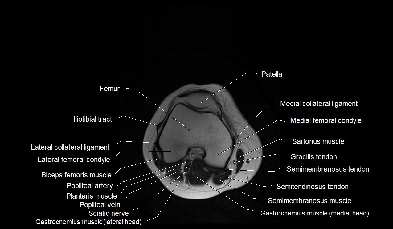 MRI thigh cross sectional anatomy image 56.webp